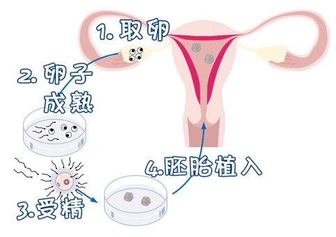 凍結胚移植